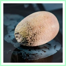 Calculous Cholecystitis