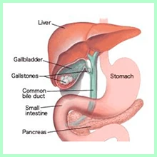 Cholelithiasis