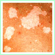 Chromophytosis