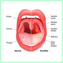 Chronic tonsillitis Chronic tonsillitis