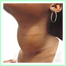 Diffuse toxic goiter