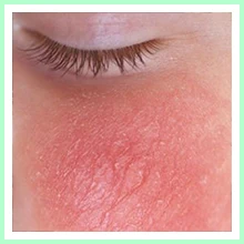 Eczema