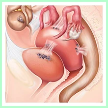 Endometriosis Endometriosis