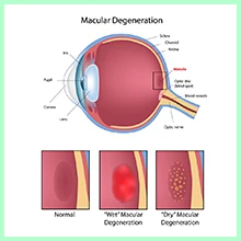 Macular degeneration Macular degeneration
