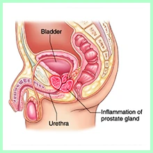 Prostatitis