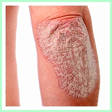 Psoriasis