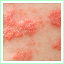 Shingles