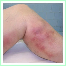 Thrombophlebitis