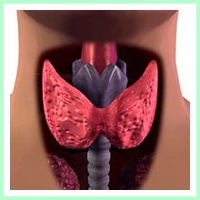 Thyroid dysfunction - Hyperthyroidism