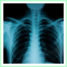 Tuberculosis Tuberculosis
