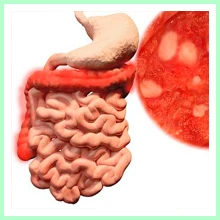 Ulcerative Colitis