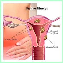 Uterine fibroids Uterine fibroids