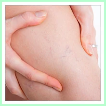 Varicose veins