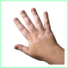 Vitiligo
